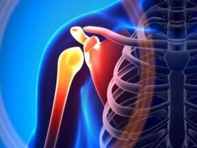 សន្លាក់ស្មារលាកដោយសារតែ arthrosis - ជំងឺរ៉ាំរ៉ៃនៃប្រព័ន្ធ musculoskeletal