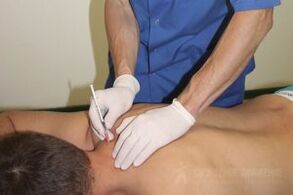 ការព្យាបាលអកម្មនៃជំងឺ atebroshondrosis