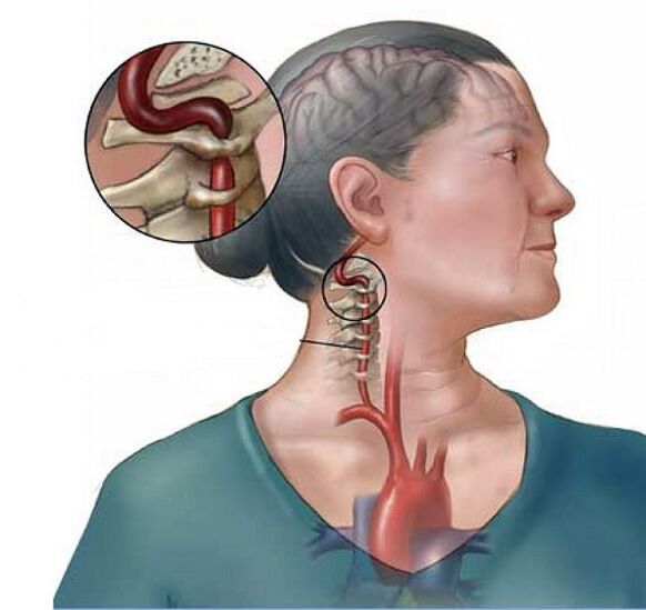 រោគសញ្ញាសរសៃឈាមវ៉ែនតាដែលមានជំងឺរលាកសន្លាក់មាត់ស្បូន