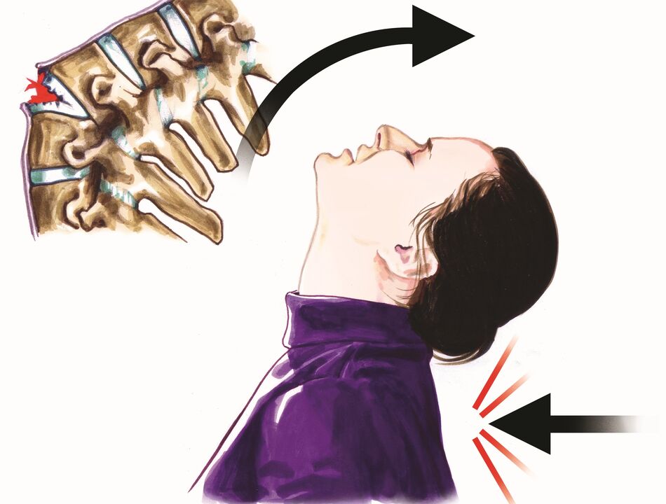 ការខូចខាតឆ្អឹងខ្នងដែលជាមូលហេតុនៃការឈឺក