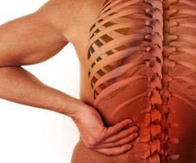 ឈឺខ្នងជាមួយ osteochondrosis ចង្កេះ