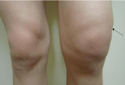 Hemarthrosis នៃសន្លាក់ជង្គង់
