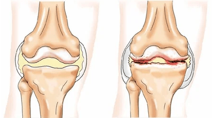 ជំងឺ Chondromatosis